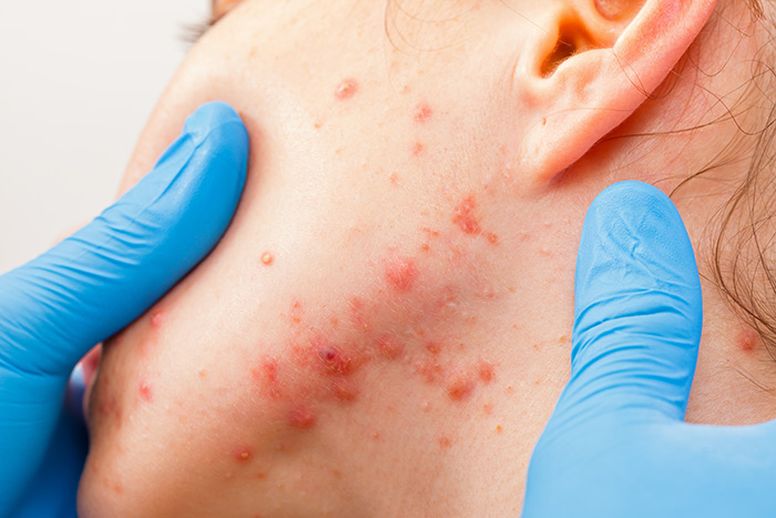 Palm Beach South Florida Dermatologists - Acne Treatments